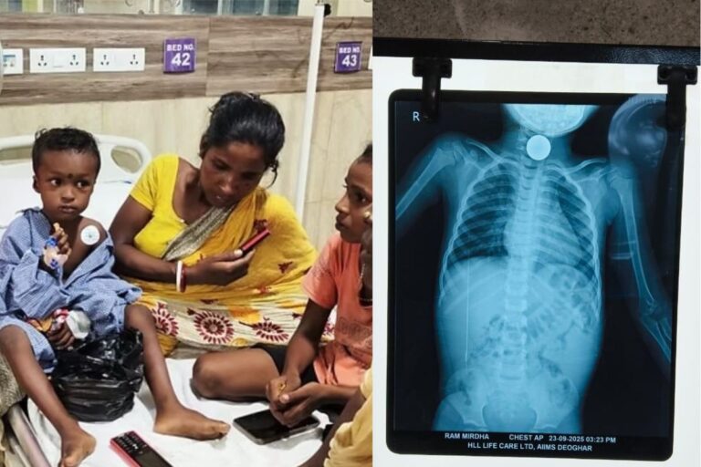 Deoghar News : देवघर AIIMS के डॉक्टरों का कमाल, 15 मिनट में निकाला बच्चे के गले में फंसा 10 रुपये का सिक्का